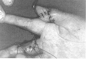 Fig. 3b - Cross-finger with second finger performed on day 22