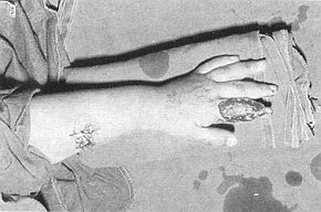 Fig. 4a - Destruction of extensor apparatus and articular capsule of proximal interphalangeal articulation of second finger of left hand recostructed with skin graft from ipsilateral forearm.