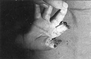 Fig. 5a - Serious electrocution of first and second finger of right hand with complete destruction of soft tissues subjected to surgical debridernent on day 11.
