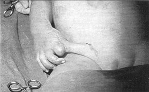 Fig. 5b - Coverage with groin flap on day 16 after further debridement.