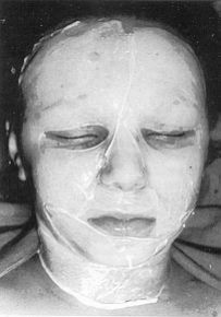 Fig. 1 - Ten-year-old child with fire burn of the face, covered with amnion. Appearance on admission.