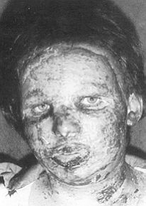Fig. 2 - Appearance after 6 days of covering with amnion. Same case.