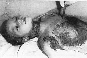 Fig. 6 - Auto-meshgrafts covered with amnion during the operation.