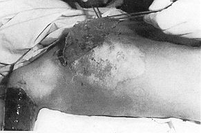 Fig. 5 - Same case. The superficial part of the burn area was epithelialized under the amnion. The granulation wound surface was prepared for operation with autografts.