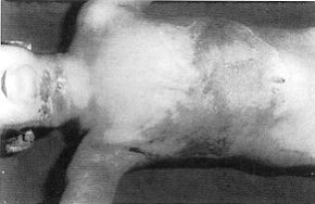 Fig. 7 - Appearance at end of treatment. Same case.