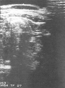 Fig. 1 - Ultrasonic scan showing hypertrophic scarring as an area between two hypodense lines.