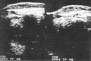 Fig. 2 (b) - Ultrasonic evaluation of patient # 7 before pressure treatment.