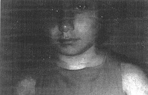 Fig. 3 (a) - Photographic evaluation of patient #7 after three months of pressure therapy.