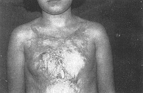 Fig. 3 (b) - Photographic evaluation of patient #7 after three months of pressure therapy.