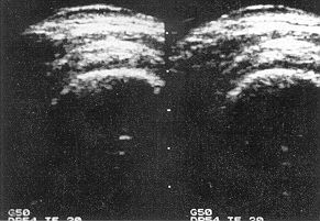 Fig. 3 (c) - Ultrasonic evaluation of patient #7 after three months of pressure therapy.