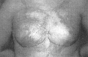 Fig. 4 (a) - Photographic evaluation showing results of pressure treatment in ninth month.