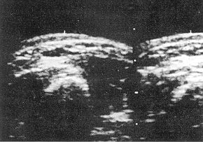 Fig. 4 (b) - Ultrasonic evaluation showing results of pressure treatment in ninth month.
