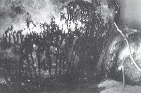 Fig. 1 - Denuded bleeding dermis in the posterior region of the thorax (pressure point).
