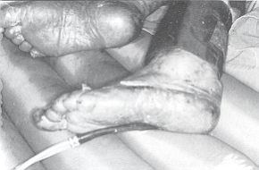 Fig. 2 - Epidermal necrolysis in both feet.
