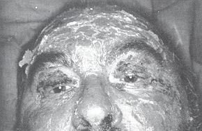 Fig. 3 - Complete reepithelialization of the face.