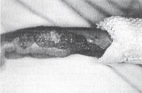 Fig. 1 - Shows polypoidal, multiple, ulcerative, coalescent granuloma pyogenicum at the bum site. Early stages of treatment.