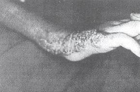 Fig. 2 - Post-treatment with cryotherapy, Fucidin cream, sytemic antibiotics and pressure application. 