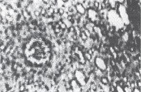 Fig. 3 - Extensive granulorna pygenicum complicating severe burns.