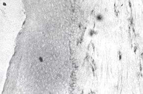 Fig. la - Colouring with the method of immunoperoxidase of cells producing TNFu,: section of epidermis and subpapillary dermis of hypertrophic scar marked with the anti-infiltrating cell (lymphocytes and macrophages) antibody. Notice the many infiltrating cells.