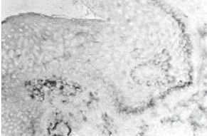 Fig 2a - Colouring with the method of immunoperoxidase of cells producing TN17B: section of normal scar marked with the anti-infiltraring cell antibody.