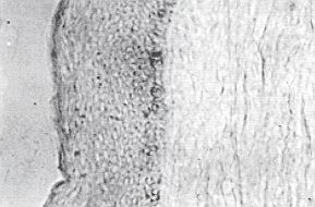 Fig. 1b - Colouring with the method of immunoperoxidase of cells producing TNFa: sequential section coloured with the anti-TNF(Y, antibody. No positivity of infiltrating cells is observed.