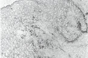 Fig 2b - Colouring with the method of immunoperoxidase of cells producing TNFB: sequential section coloured with the anti-TNFB antibody. The cells in both fields are positively marked.