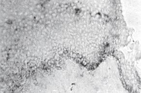 Fig. lc - Colouring with the method of immunoperoxidase of cells produc-ing TNFa: section of epidermis of normal scar coloured with antiinfiltrating cell antibodies. The cells are coloured positively and are comparable to those of the sequential sequence.