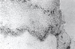 Fig. 1d - Colouring with the method of immunoperoxidase of cells producing TNFa: sequential section marked with the anti-TNF(Y. antibody.
