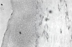 Fig 2d - Colouring with the method of immunoperoxidase of cells producing TNFB: sequential section marked with the anti-TNFB antibody. The cells present in the field observed are marked with both antibodies.