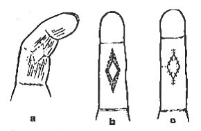 Fig. 1 - Drawings of the procedure a) outline of incision b) rhomboid release (dotted area indicates the extent of release).