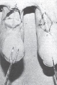 Fig. 2 - Pre-operative appearance of long-standing digital contractures in index and middle fingers of left hand and drawings of incisions.