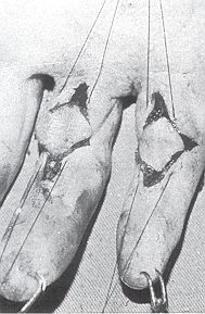 Fig. 3 - Intra-operative appearance of the procedure.