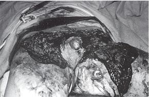 Fig. 2c - Vue propratoire. Vaste dbridement.