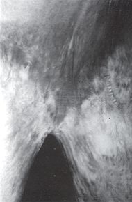Fig. 3a - Séquelle de brûlure bi-inguinovaginale. Vue préopératoire antérieure. 