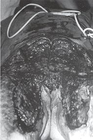 Fig. 3c - Vue propratoire. Vaste dbridement.