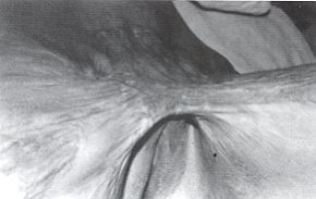 Fig. 4a - Séquelle de brûlure bi-inguinale. Plastie en Z bilatérale. Aspect préopératoire