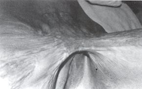 Fig. 4a - Squelle de brlure bi-inguinale. Plastie en Z bilatrale. Aspect propratoire