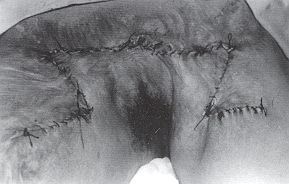 Fig. 4b - Aspect postoperatoire