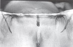 Fig. 5a - Squelle de brlure bi-inguinale. Plastie en trident. Aspect propratoire.