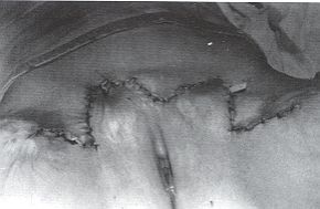 Fig. 5b - Aspect postopratoire.