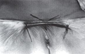 Fig. 6a - Squelle de brlure inguinopubienne. Plastie en trident. Aspect propratoire.