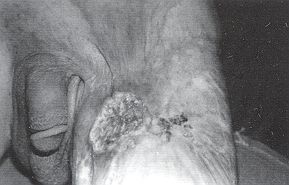 Fig. 7a - Epithlioma spinocellulaire sur squelle de brlure inguinale. Vue propratoire.
