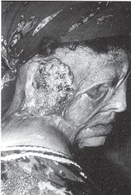 Fig. la - Epithlioma spinocellulaire sur squelle de brlure de la face. Vue propratoire, profil.