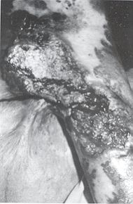 iFig. 2a - Epithélioma spinocellulaire sur le versant postérieur d'une séquelle de brûlure du creux axillaire et du bras. 