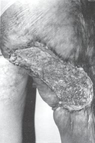 Fig. 3a - Epithliorna spinocellulaire sur squelle de brlure de la fesse et de la face postrieure de la cuisse. Vue propratoire.