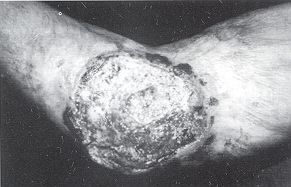 Fig. 4 - Epithéliorna spinocellulaire de la face interne du coude sur séquelle de brûlures.
