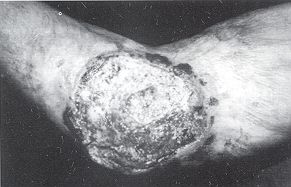 Fig. 4 - Epithliorna spinocellulaire de la face interne du coude sur squelle de brlures.