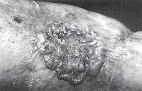 Fig. 5 - Epithéliorna spinocellulaire sur séquelle de brûlure de la face interne du bras.