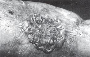 Fig. 5 - Epithliorna spinocellulaire sur squelle de brlure de la face interne du bras.