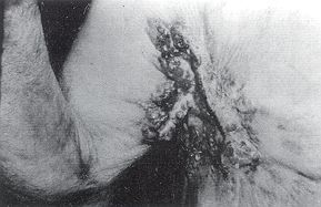 Fig. 6a - Epithélioma spinocellulaire sur le versant antérieur d'une séquelle de brûlure axillo-brachio-latéro-thoracique. Vue préopératoire.